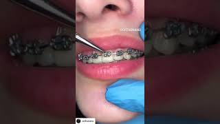 Figure of 8 ligature placement on brackets #shorts