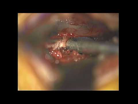 Lumbar Microdiscectomy using the Spine Jet