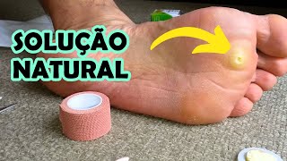 Olho de Peixe no P - Como Tirar e Resolver Isso