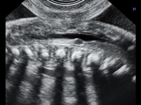 ISUOG: Cyst of the filum terminale