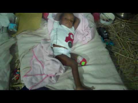 Jean Pierre, an orphan with leg amputated in Haiti from the earthquake