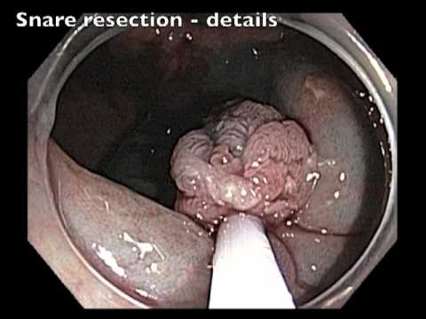 Ileocecal Valve: Flat Lesion - Snare