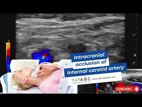 Intracranial occlusion of the internal carotid artery | Ultrasound