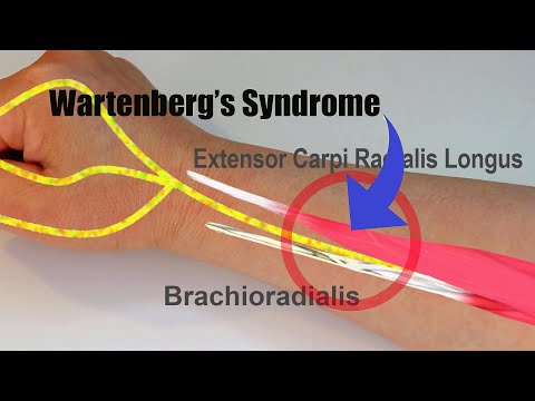 Wartenberg's Syndrome