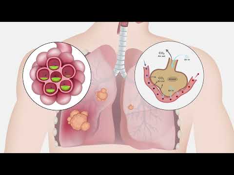 Lung Cancer | Pathophysiology and Nursing Interventions