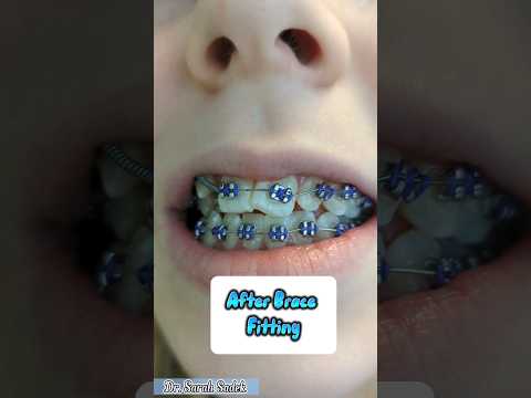 Before and After Brace Fitting Appointment #shorts #braces