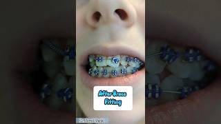 Download lagu Before and After Brace Fitting Appointment #shorts #braces mp3 Download lagu Before and After Brace Fitting Appointment #shorts #braces mp3