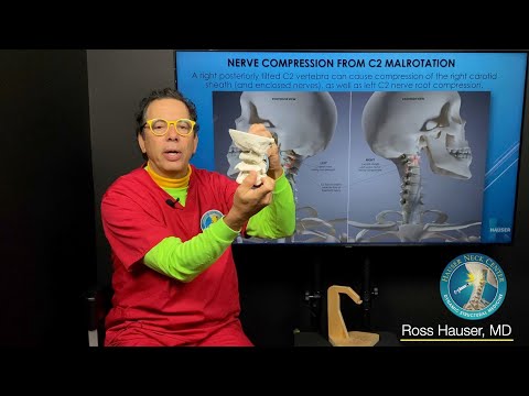 C2 malrotation symptoms and treatment options when cervical instability is the cause