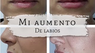 Mi Aumento de Labios | Vivanta Tenerife
