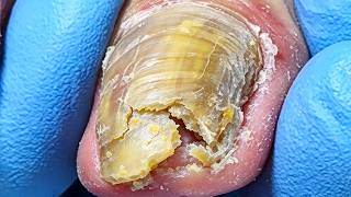 Long Vertical Onychomycosis, Clean The Deteriorated Nails【Xue Yidao】