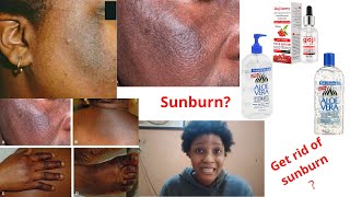 How to get rid of sunburn and redness of the face fast using this products /#sunburn treatment
