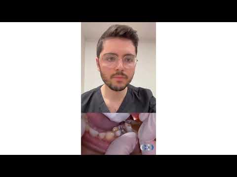 Astuce pour déposer un tenon métallique – Prothèse