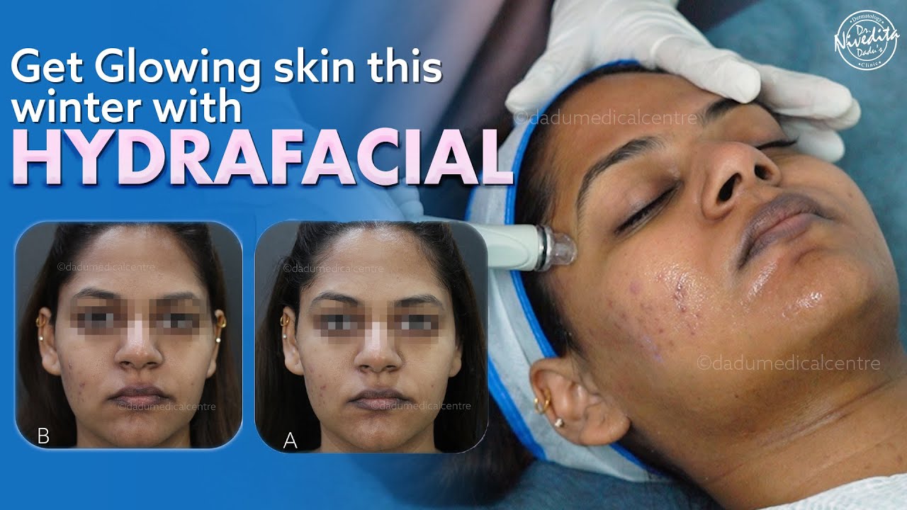 Get Glowing Skin This Winter With Hydrafacial