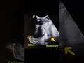 Hydatid Cyst In Spleen Ultrasound Ultrasonido Hydatidcyst Spleen Quístehidatídico Bazo