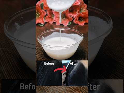 Dandruff treatment at home | Remove dandruff in one wash | Dandruff hair mask #haircare #shorts #yt