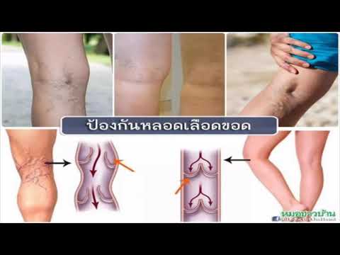 ครีมสำหรับเปลือกตากลาก โรคสะเก็ดเงินใน Kim Kardashian