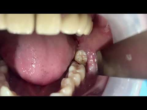 Video On The Complicated Molar Dental Extraction