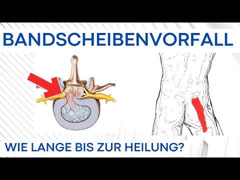 Bandscheibenvorfall - Wie lange bis zur Nervenheilung?