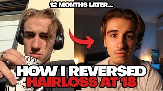 How To Reverse Hair Loss In 12 months (No Bullsh*t Protocol)