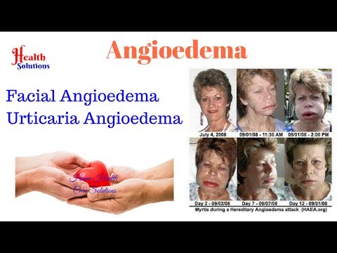 Angioedema - Facial Angioedema - Urticaria Angioedema Video