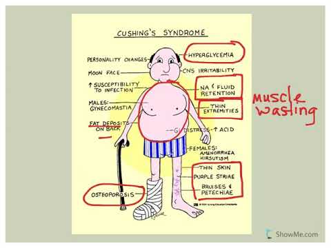 Endocrine Disorders