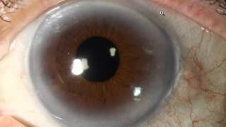 Iridology Lesson#1 Cholesterol / Lymph Rings