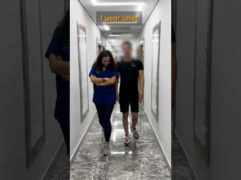From 170 cm to 178 cm: Leg Lengthening Surgery Recovery Update