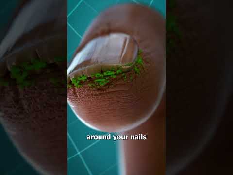 Why You Shouldn't Bite Your Nails 😖
