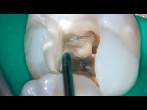 Treatment of a necrotic mandibular molar according to the Biologic Endodontic School. Domenico Ricucci.