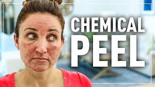 CHEMiCAL PEEL: Mindy Gets a New Face