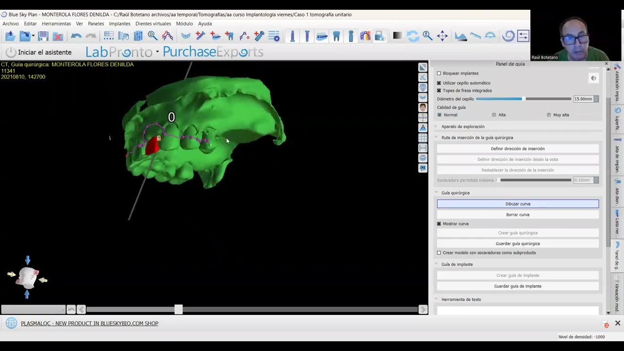 Confección de la férula para CIRUGÍA GUIADA Blue Sky Plan