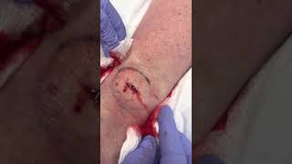 Lipoma removal from wrist