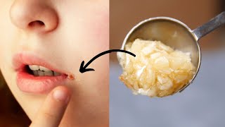 How To Heal Cracked Lip Corners Fast - Get Rid Of Angular Cheilitis Fast At Home