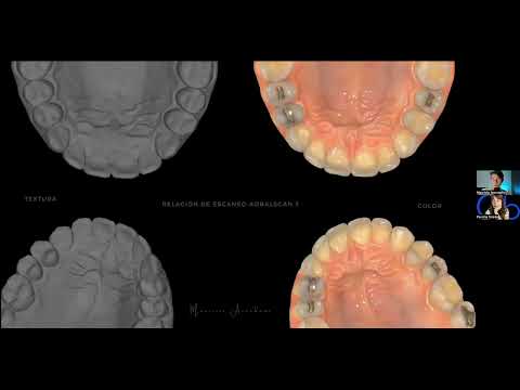 Impresión 3D de guardas dentales