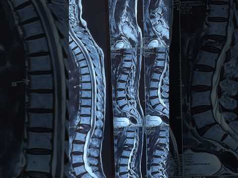 Spine Osteoporotic vertebral compression fracture in elderly : how to treat #spinehealth #backpain