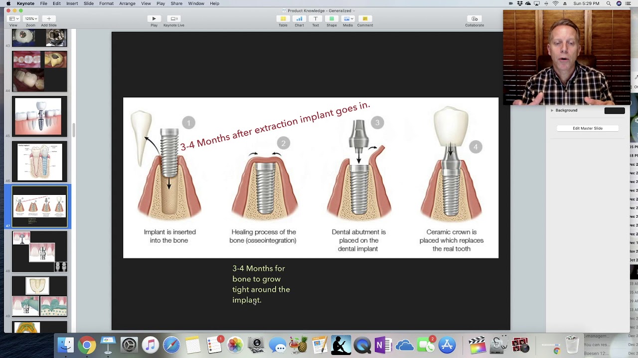Implant   Basic Introduction. Education for dental staff.