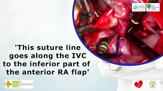 Modified Senning's Operation - Tips and Tricks