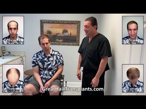 Dr. Brett Bolton Patient Tim MaxHarvest Plus  Procedure




