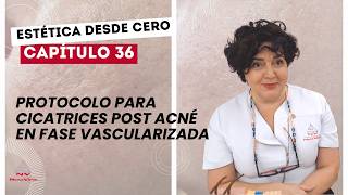 [Est. desde 0] Cap 36: Protocolo para cicatrices post acné en fase vascularizada