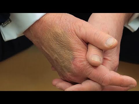 President Trump blames bruising on high Aspirin dose, insists his health is perfect