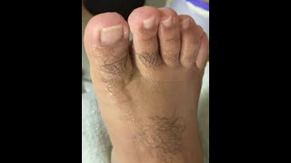Ep_8302 Foot nails skin removal 👣 ผมมีอาการ..ตอนใส่รองเท้าครับ 😄 (clip from Thailand)