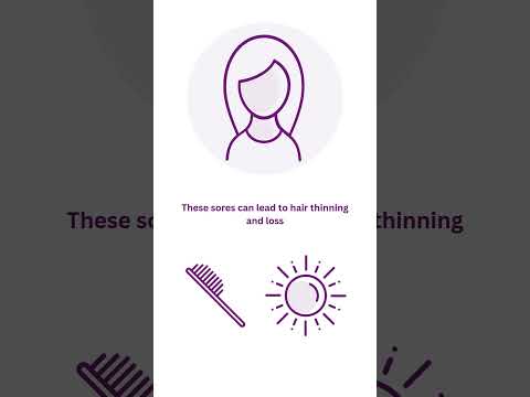 The Four Types of #Lupus