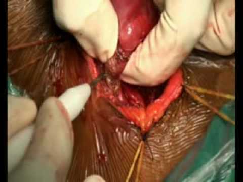 comment traiter nodule thyroidien