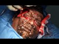 Surgery to Remove a Large Facial Tumor | Ravikumar Complete Surgery