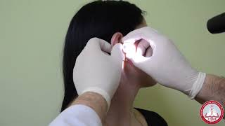 Купить Riester Лобный рефлектор Ziegler