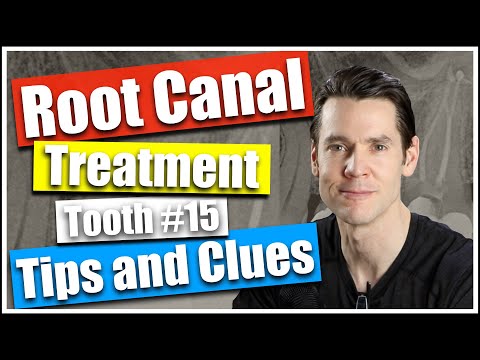 Root Canal #15, Cyclic Fatigue, Canal Location and Canal Confluence