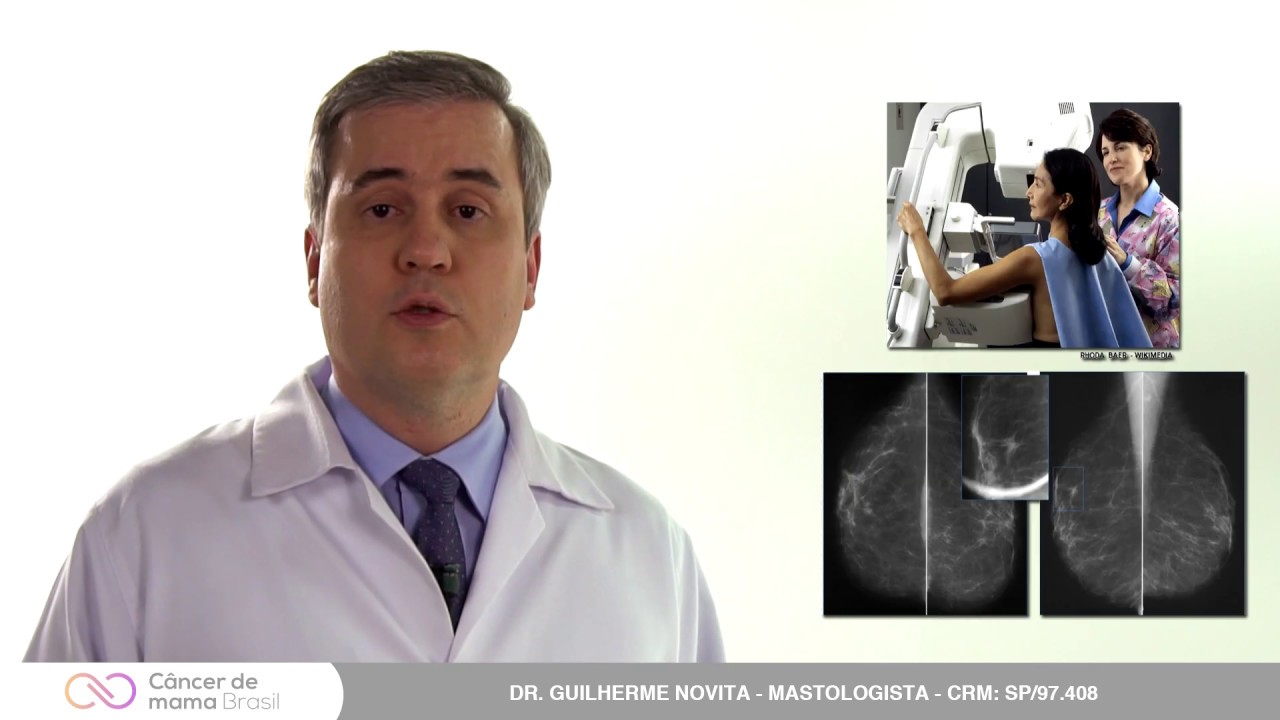 CARCINOMA INVASIVO DE TIPO NÃO ESPECIAL (SEM OUTRA ESPECIFICAÇÃO - SOE)/ CARCINOMA DUCTAL INVASIVO