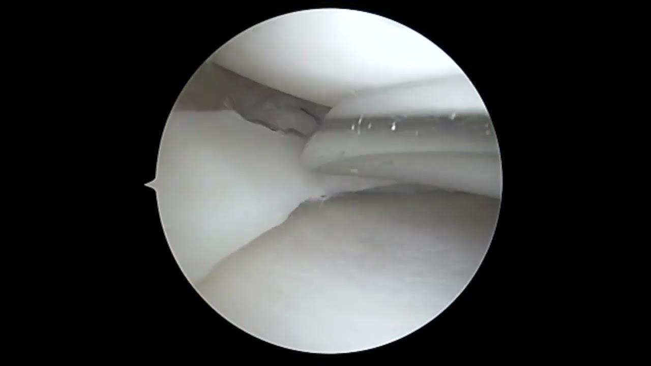 Complex Meniscus Repair: Using multiple techniques