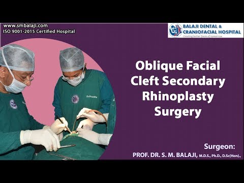 Oblique Facial Cleft Secondary Rhinoplasty Surgery