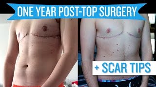 One Year Post Top Surgery + Scar Tips